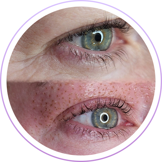 Fibroblasting Skin Tightening